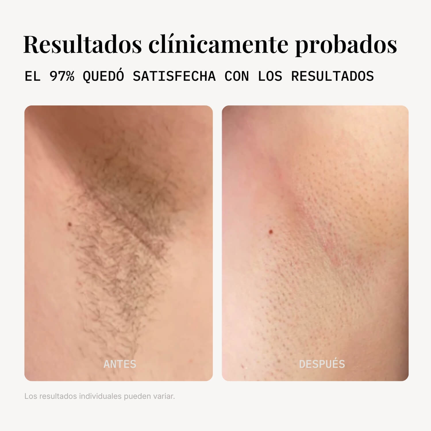 IPL lumira S10 pro