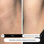 Depiladora Láser IPL Lumira