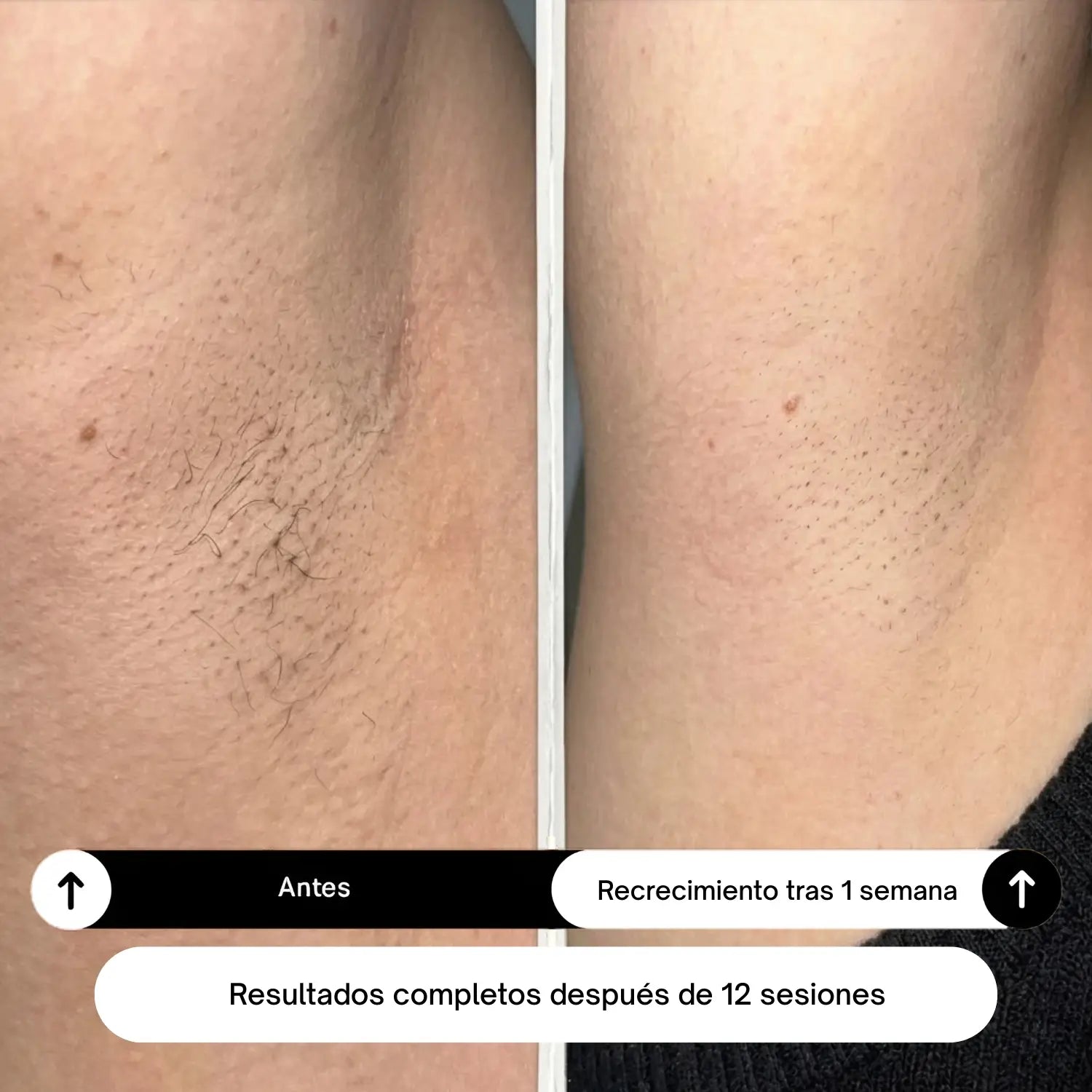 Depiladora Láser IPL Lumira