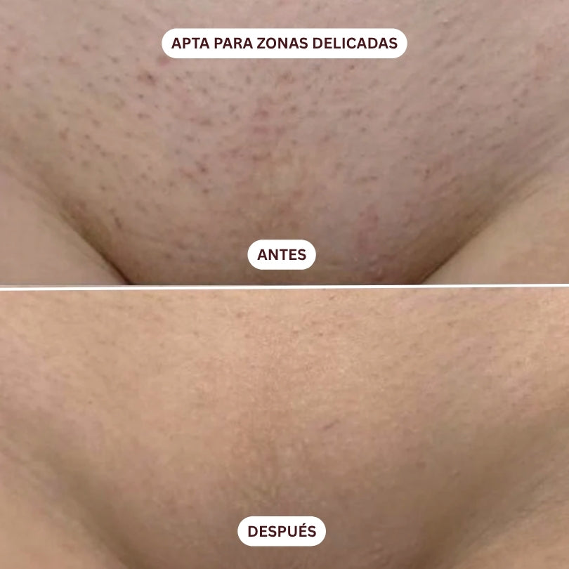 Depiladora Láser IPL Lumira