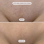 Depiladora Láser IPL Lumira