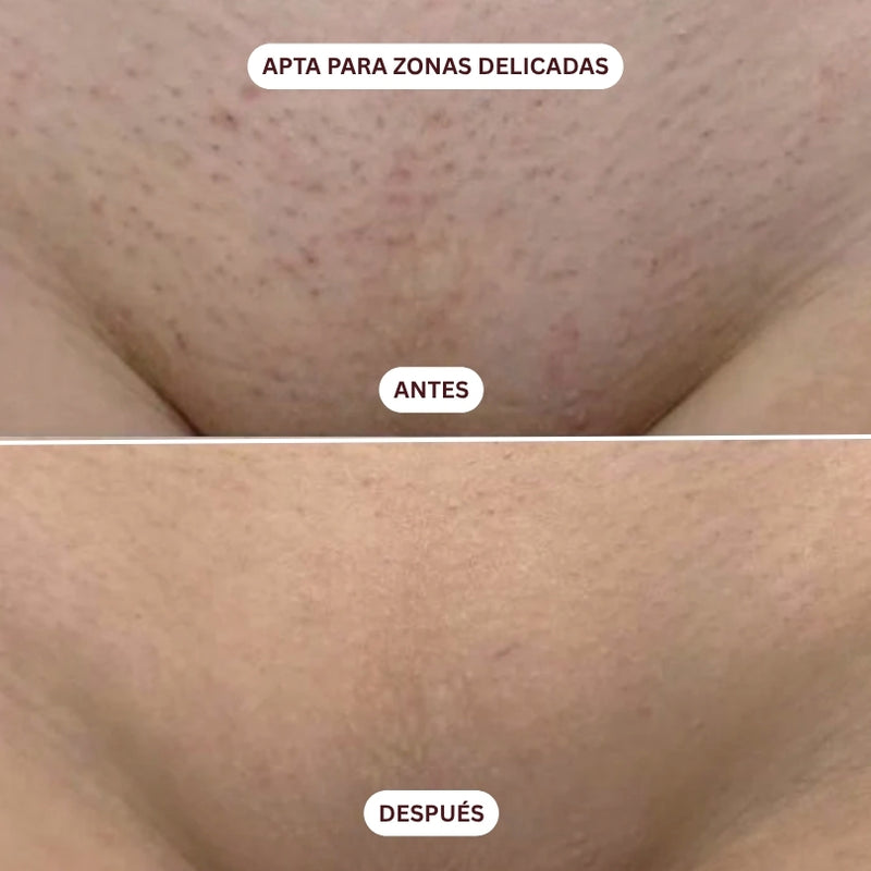 Depiladora Láser IPL Lumira Hover