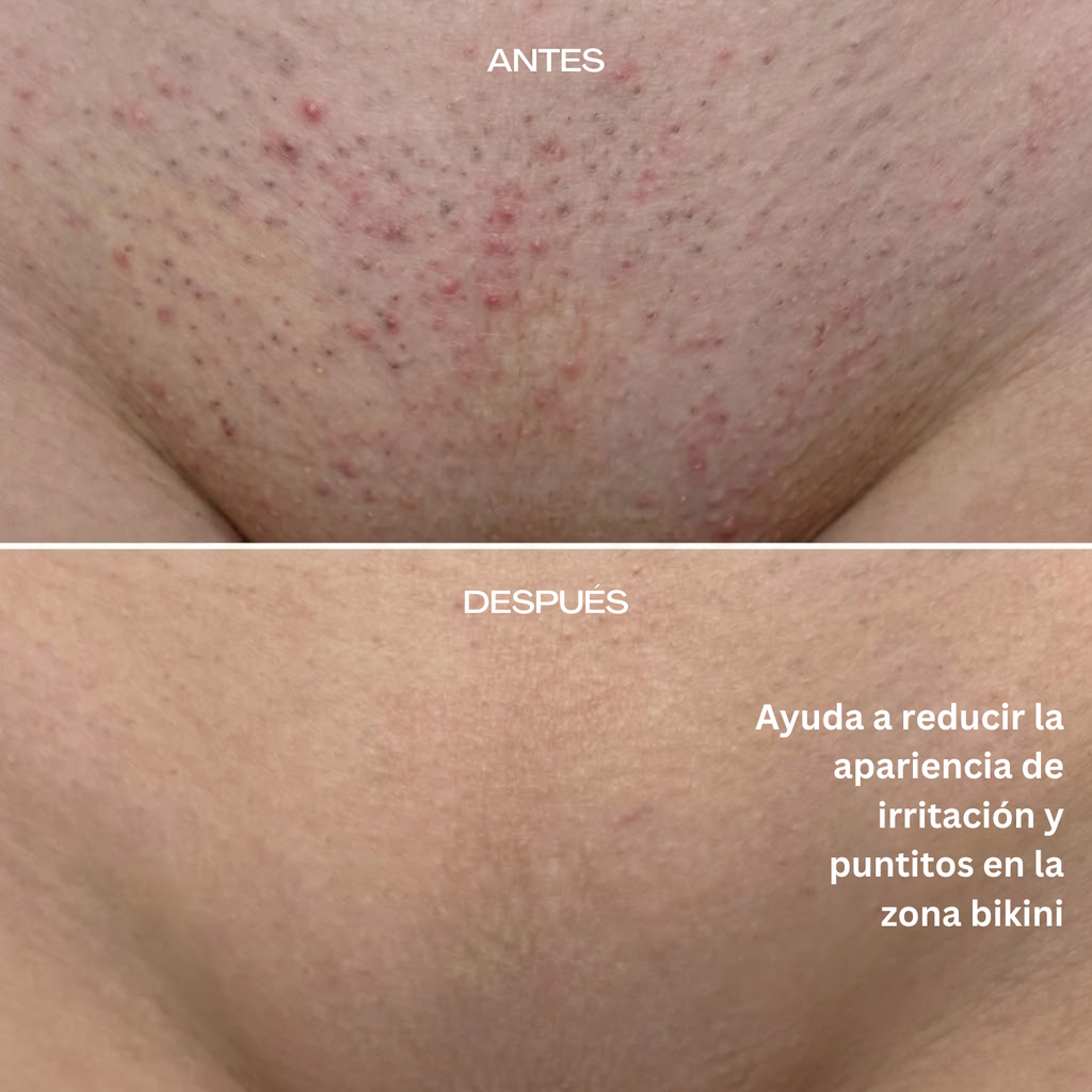resultados lumira S10 Pro 1200nm depiladora laser ipl profesional