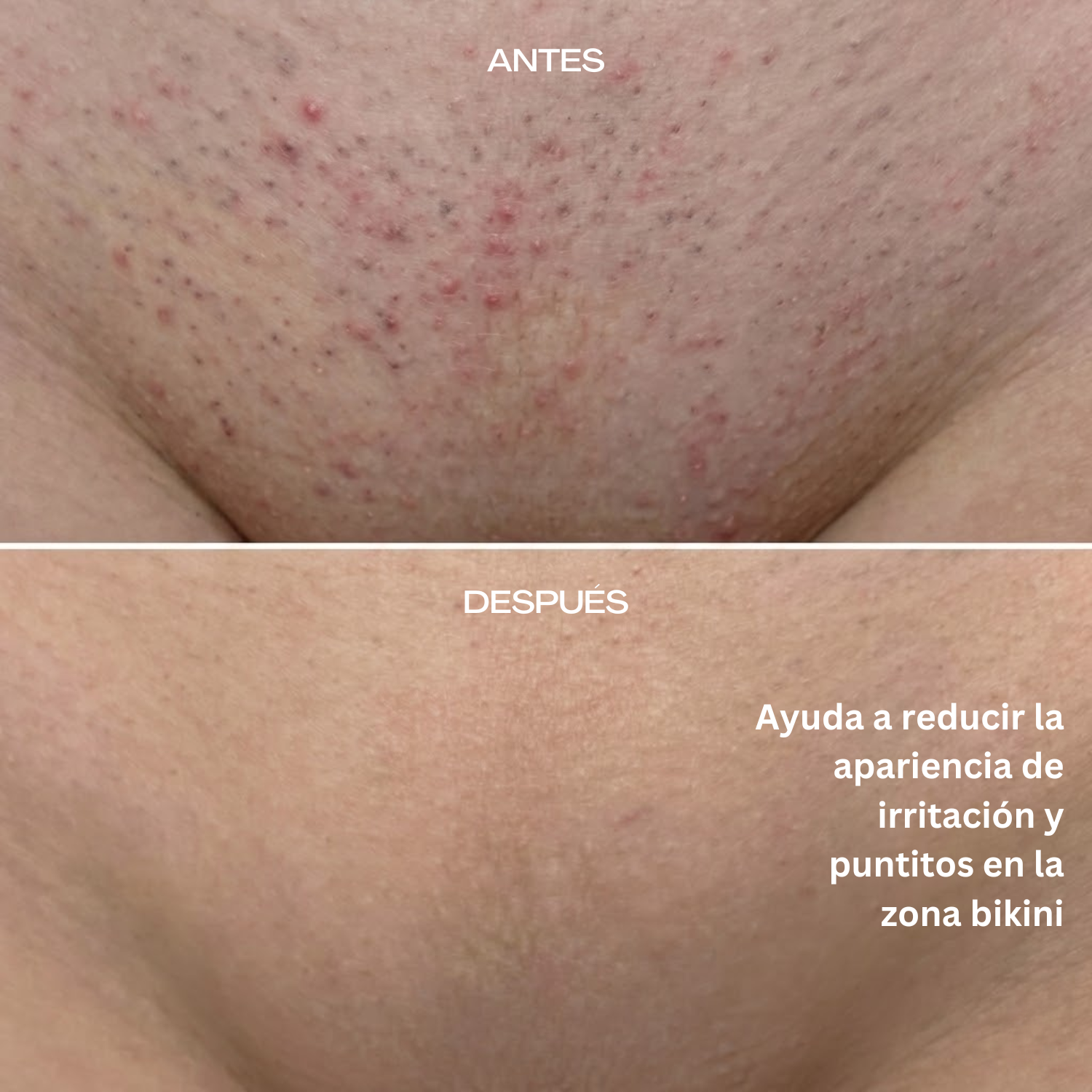 resultados lumira S10 Pro 1200nm depiladora laser ipl profesional